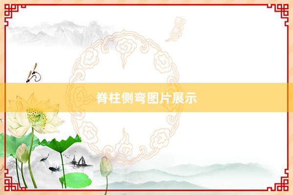 脊柱侧弯图片展示